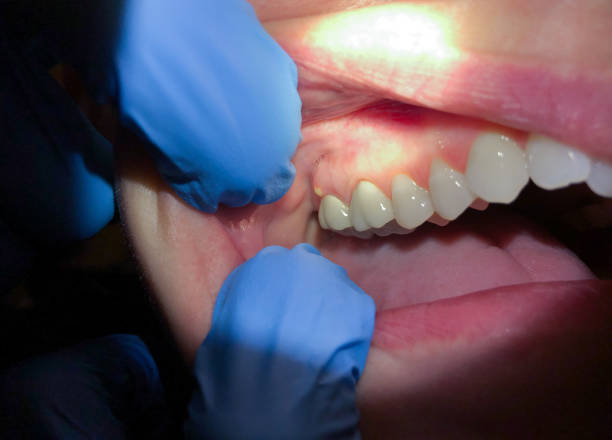 Best Cracked Tooth Emergency Dentist  in Stockton, CA
