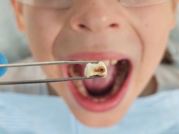 Best Root Canal Emergency Dentist  in Stockton, CA